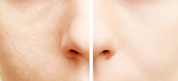 Can I get rid of pimple scars