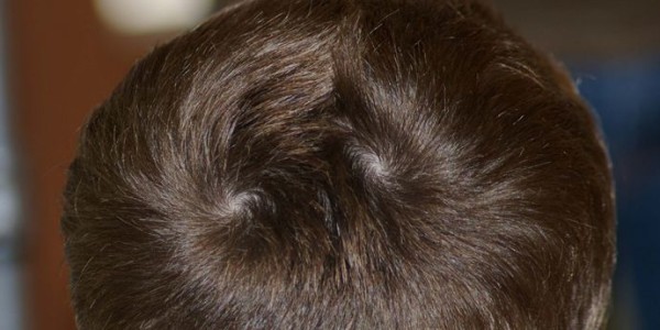 What is a Cowlick