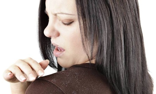 How to get rid of Dandruff Naturally