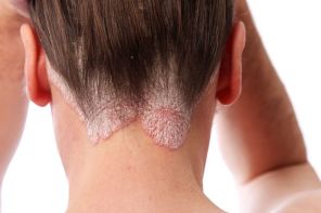 Natural Home Remedies for Psoriasis